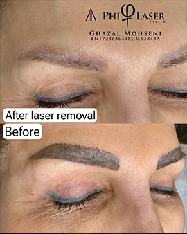 Laser