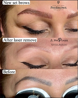 Laser