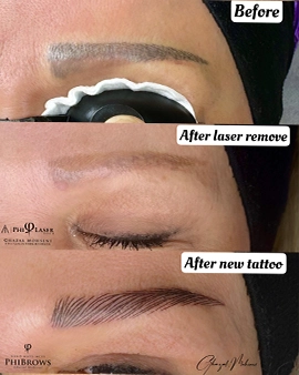Laser