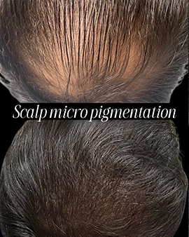 pigmentation