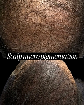 pigmentation